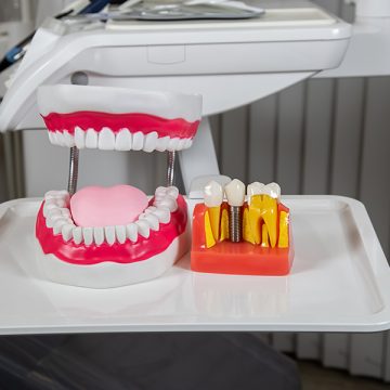 How Long Do Implant-Supported Dentures Last?