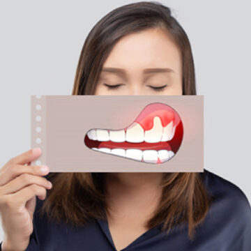 Nurturing Your Smile: A Comprehensive Guide to Gum Therapy