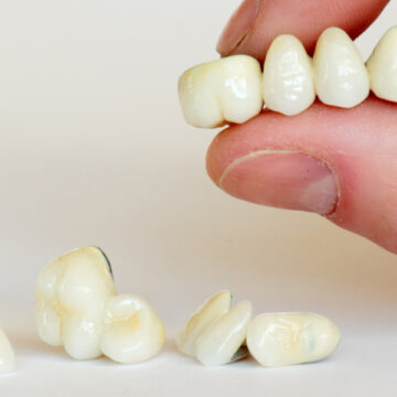 The Ultimate Guide to All-Porcelain Dental Crowns – Enhancing Smiles with Natural-Looking, Durable Restorations