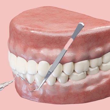 What Is Gum Reshaping and How Can It Improve Your Smile?