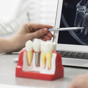 Dental Implants Across Age Groups: What You Need to Know