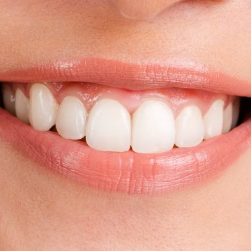 Teeth Straightening Options: Finding the Best Solution for a Perfect Smile