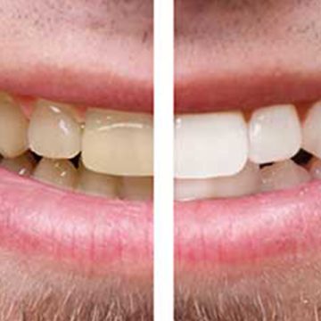 ZOOM! Tooth Whitening: An Effective Way to Whiten Your Teeth