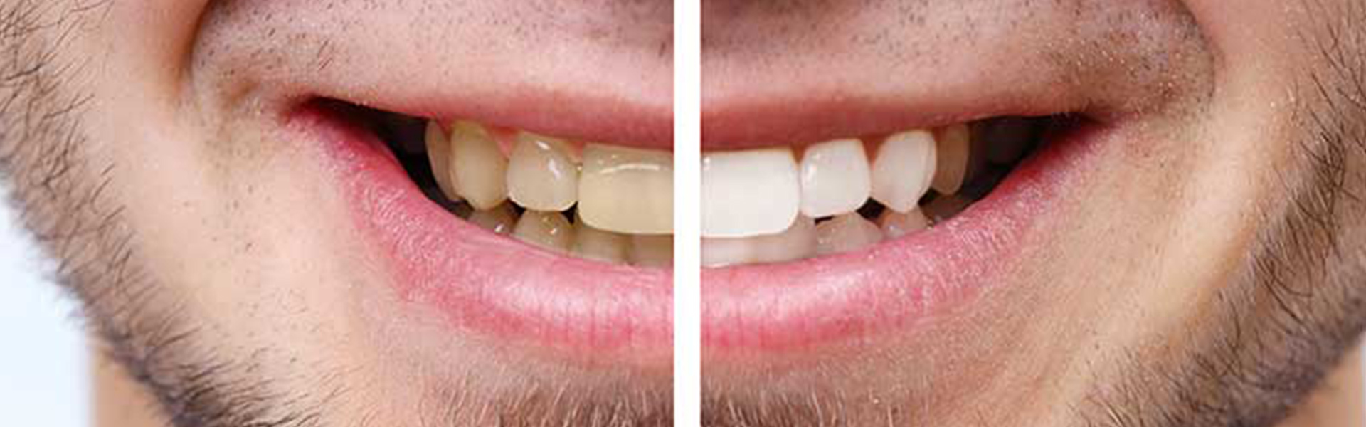 ZOOM! Tooth Whitening: An Effective Way to Whiten Your Teeth